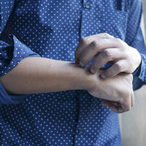 Co zrobić żeby ugryzienie komara znikło? Sprawdzone sposoby na ulgę