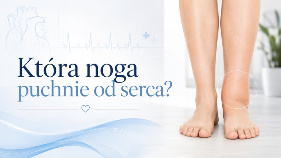 Która noga puchnie od serca? Odkryj przyczyny i rozwiązania